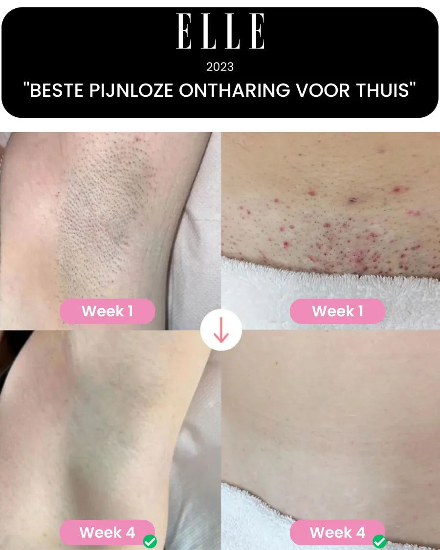 PERMANENTNÍ EPILÁCE NA CELÉ TĚLO