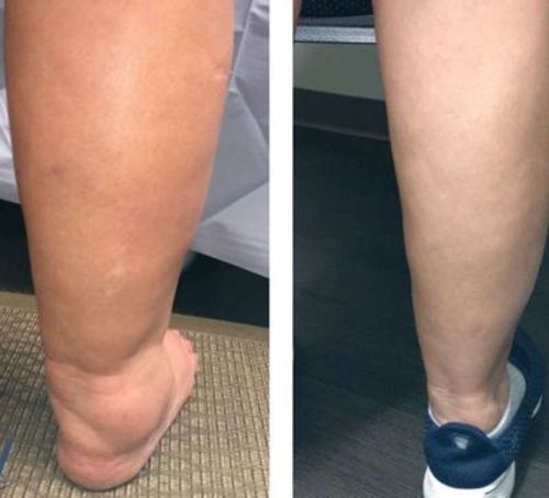 DOPRAVA ZDARMA AFIZTM TURMALÍNOVÁ ZDRAVOTNÍ PONOŽKA NA HUBNUTÍ LYMFY